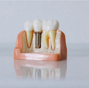 How-to-choose-the-best-dental-implant-service-in-Redlands